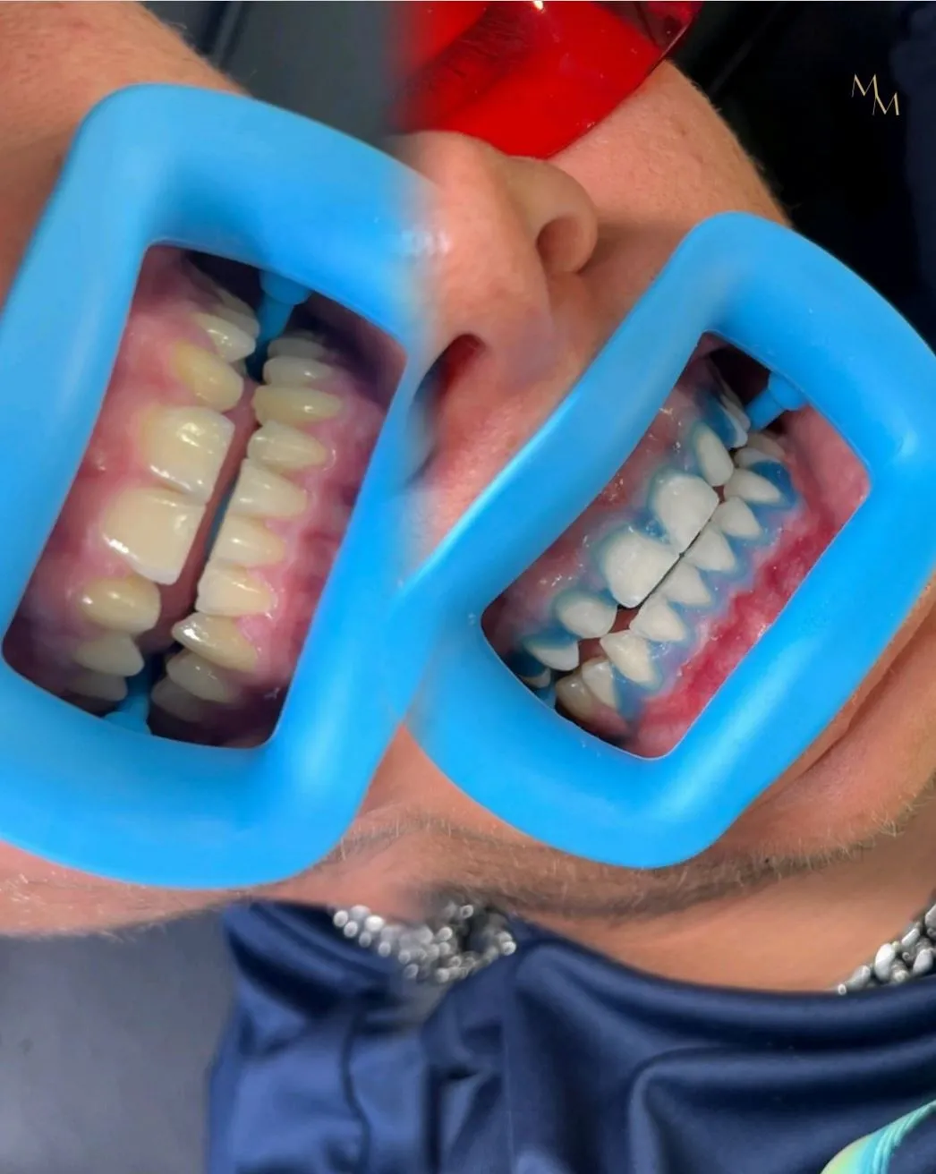 Quick tips for a longer-lasting white smile