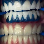 Why Is Professional Teeth Whitening So Expensive