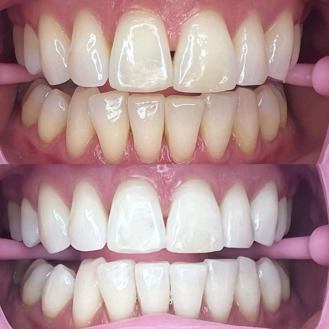 teeth whitening