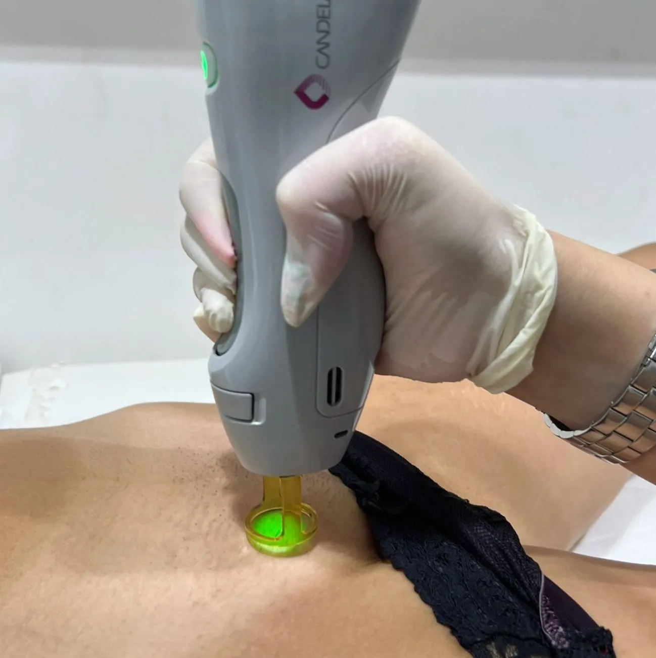 What does Brazilian hair removal include