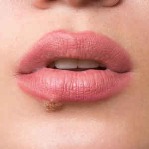 What’s the Best Way to Treat a Cold Sore After a Lip Tattoo